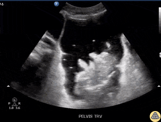 Bowel-GI - Ascites with Pneumoperitoneum