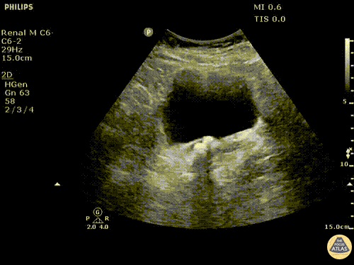 Renal/GU - Ureteral Stones at Ureterovesical Junction