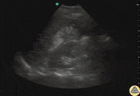 Biliary - Ruptured Viscus from Trauma
