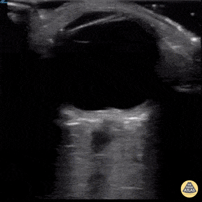 Orbital - Papilledema