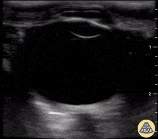 Orbital - ONSD for ICP