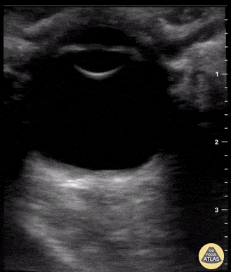 Orbital - ONSD normal ICP
