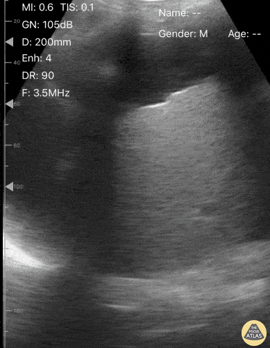 Bowel-GI - Floating Liver