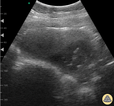 OB/Gyn - Intrauterine Pregnancy