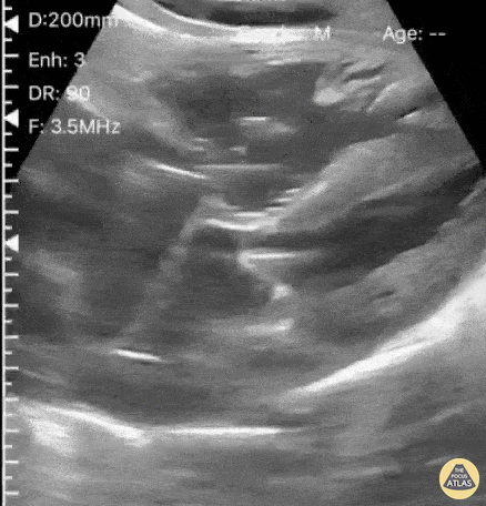 Other Cardiac Pathology - Bubble Study for CVL Verification