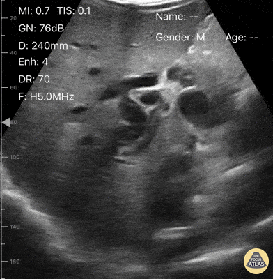 Biliary - Extreme GB distention in setting of cholangiocarcinoma