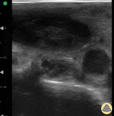 Vascular - VTE in PE