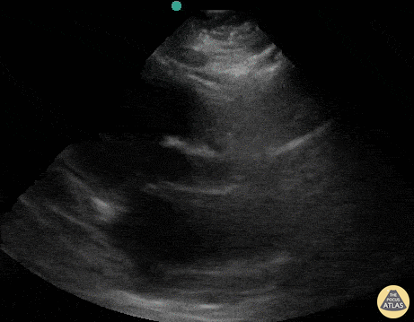 EA Echo Examples - Cardiac Standstill