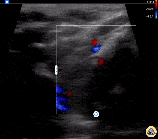 Soft Tissue - COVID-19 Thyroiditis