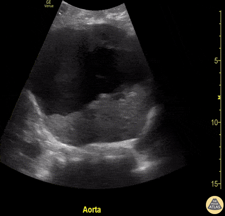 Aorta - Abdominal Aortic Aneurysm