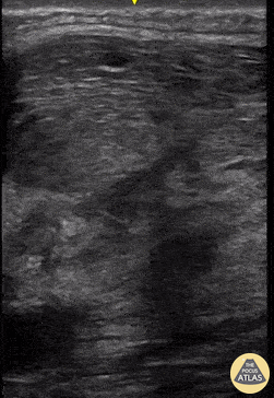 Musculoskeletal - Pyomyositis