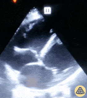 Other Cardiac Pathology - Bi-Ventricular Thrombi