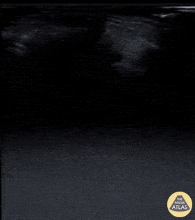 Orbital - Retrobulbar Hematoma