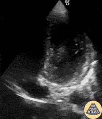 Pericardial Disease - Acute Pericarditis