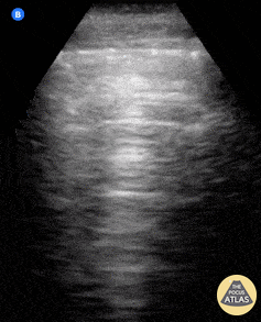 Pulmonary - Normal lung