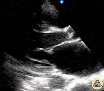 Left Ventricular Dysfunction - Atrial fibrillation