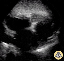 Normal Cardiac Anatomy - Normal subcostal view