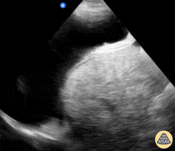 Bowel-GI - Hepatic hydrothorax