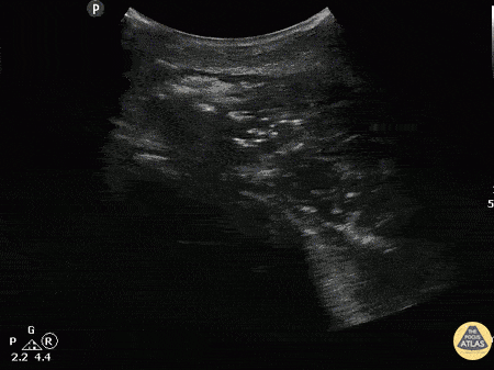 Musculoskeletal - Myonecrosis of Deltoid