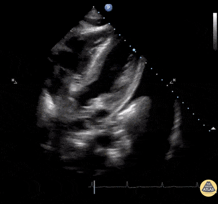 Pericardial Disease - Ascites, Pericardial Effusion & Left Pleural Effusion