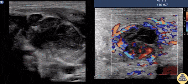 Soft Tissue - Suppurative Lymphadenitis