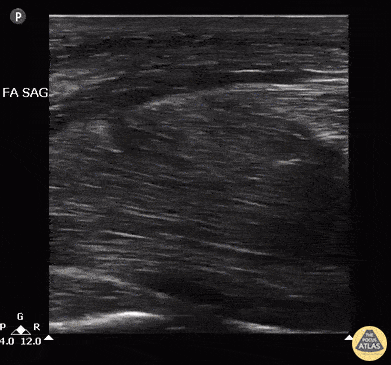 Musculoskeletal - Intramuscular Abscess after IVDU injection