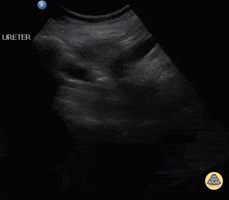 Renal/GU - Distal Ureteral Stone