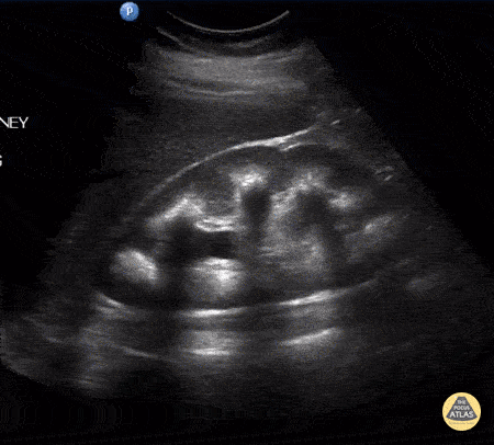 Renal/GU - Medullary Nephrocalcinosis with Moderate Hydronephrosis