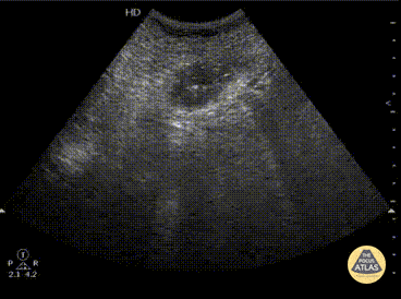 Bowel-GI - Gallstone Ileus