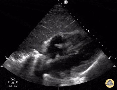 Valvulopathy - Tricuspid Endocarditis