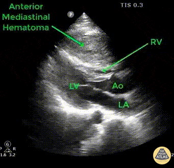 Other Cardiac Pathology - Anterior Mediastinal Hematoma