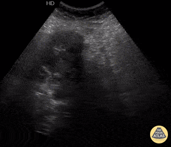 Trauma - Ruptured Hepatic Hydatid Cyst