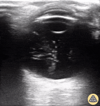 Orbital - Asteroid hyalosis (an ultrasonographic mimic of vitreous hemorrhage)