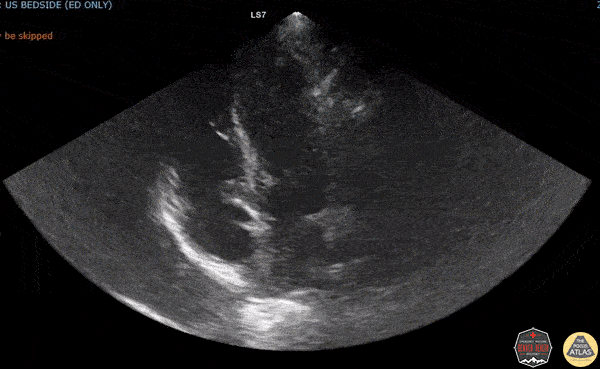 Valvulopathy - Endocarditis in an Intravenous Drug User