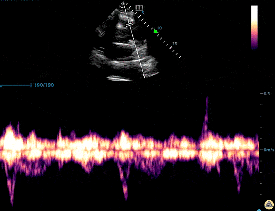 EA Echo Examples - Pulmonary Artery Mid-systolic Notching (aka MSN pattern)