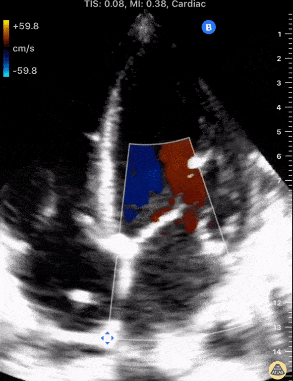 Valvulopathy - Functional MR in Heart Failure