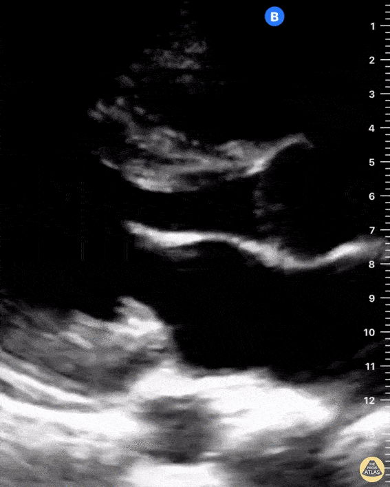 Normal Cardiac Anatomy - Normal Parasternal Long
