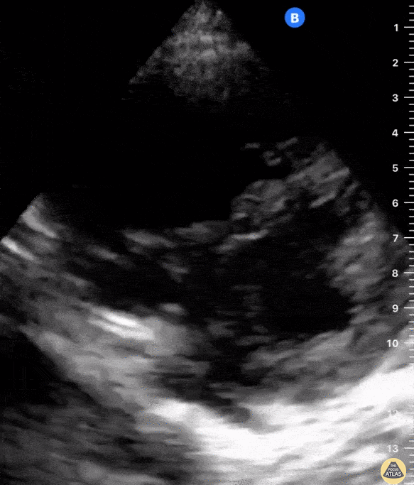 Right Ventricular Dysfunction - D-Shaped Septum