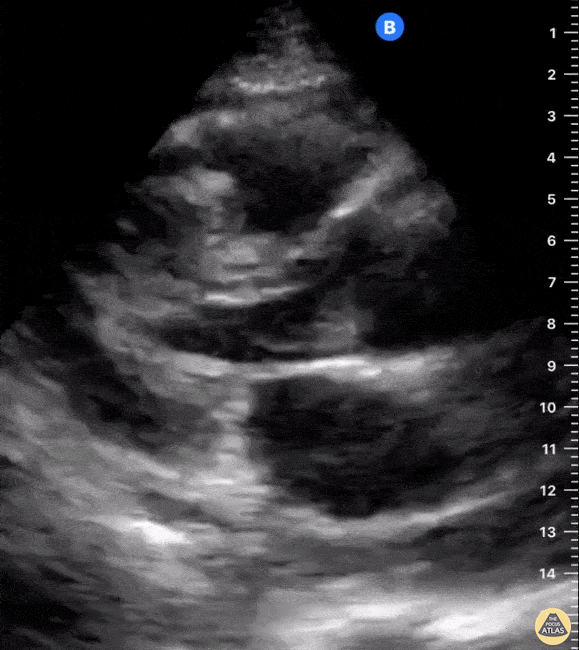 Pericardial Disease - Cardiac Tamponade