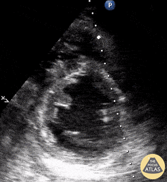 Left Ventricular Dysfunction - Parasternal Short Axis: Sepsis-induced cardiomyopathy