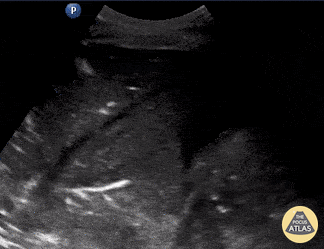 Pulmonary - Hepatization of Lung