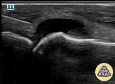 Musculoskeletal - US-Guided MTP Arthrocentesis