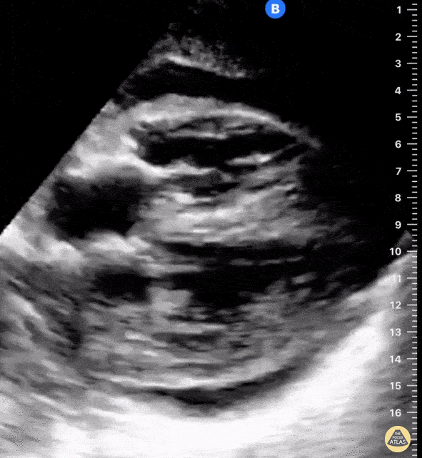 Pericardial Disease - Pericardial Tamponade
