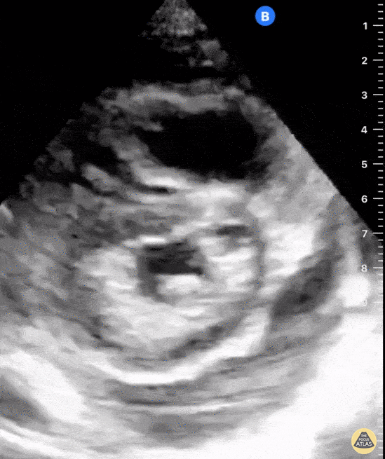Right Ventricular Dysfunction - RV Strain