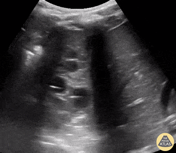 Pediatrics - Hepatization of the Lung