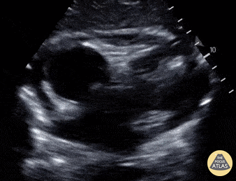 Pediatrics - Pericardial Effusion