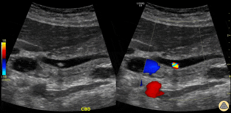 Biliary - Twinkling Artifact in Choledocholithiasis