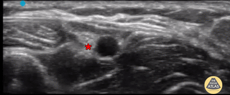 Nerve Block Gallery - Radial Nerve Block