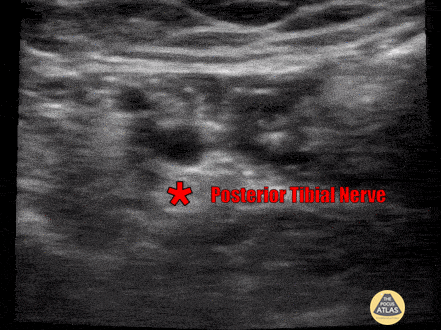 Nerve Block Gallery - Posterior Tibial Nerve Block