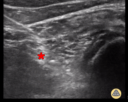 Nerve Block Gallery - Popliteal Sciatic Nerve Block